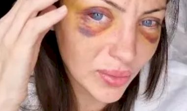 Brazilian influencer “Inhuman Barbie” dies at 31 after undergoing 27 cosmetic surgeries