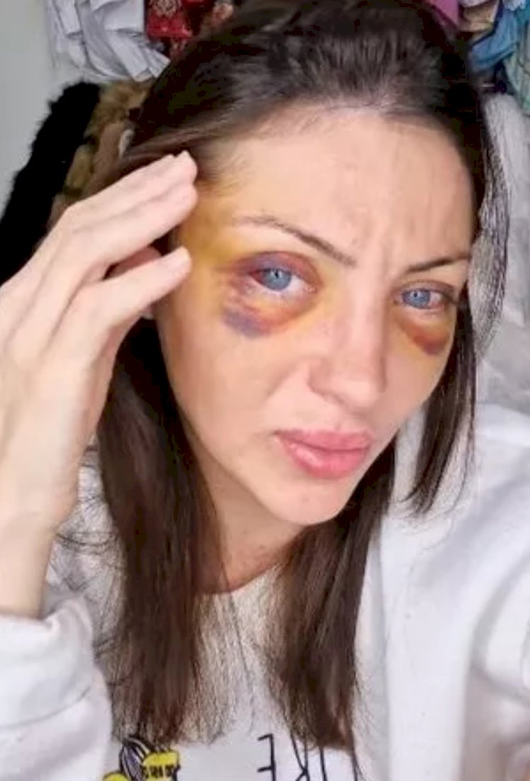 Brazilian influencer “Inhuman Barbie” dies at 31 after undergoing 27 cosmetic surgeries